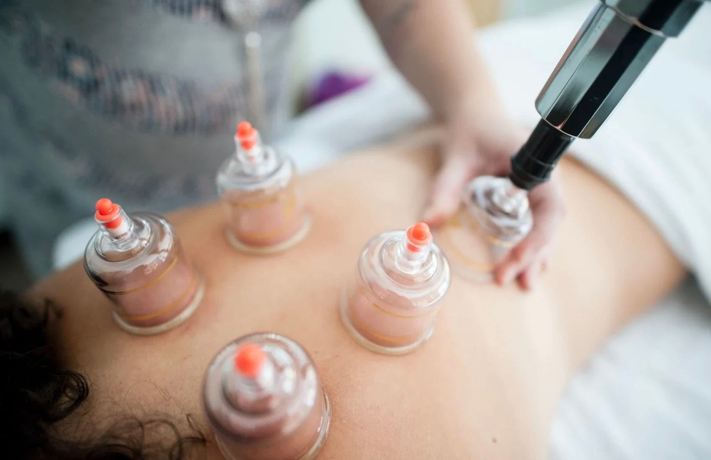 Cupping Therapy